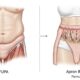 What are FUPA: How to Distinguish Stubborn Pubic Fat from an Apron Belly